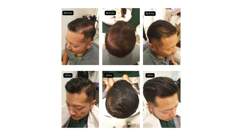 A before and after comparison of a man - having thin hair before and having thick, luscious hair after