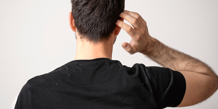 Scalp irritation