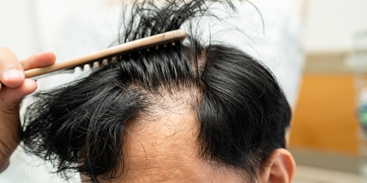 Scalp buildup