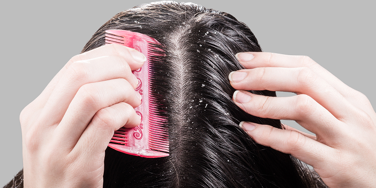 Scalp irritation